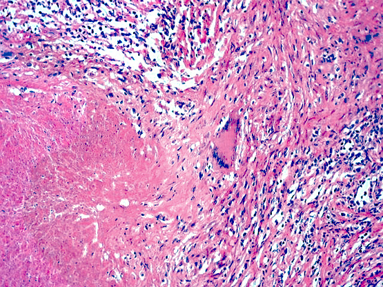 Pathology Outlines - Tuberculosis